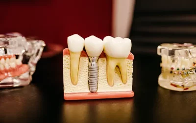 The Comprehensive Guide To Understanding Dental Bone Graft Surgery
